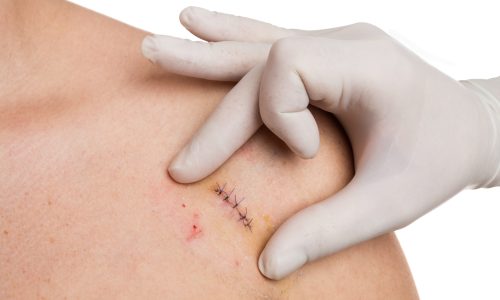 Skuldersmerter efter operation