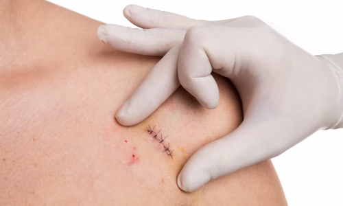 Skuldersmerter efter operation